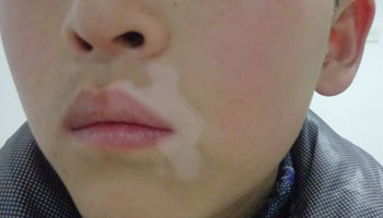 怎么诊断小孩子脸上白斑是不是白癜风